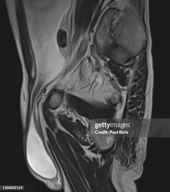 inguinal hernias seen on mri image, sagital t2 image - hernia inguinal stock pictures, royalty-free photos & images