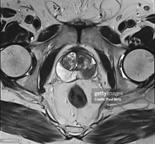 peripheral zone prostate cancer on the left, mri axial t2 image - prostate cancer stockfoto's en -beelden