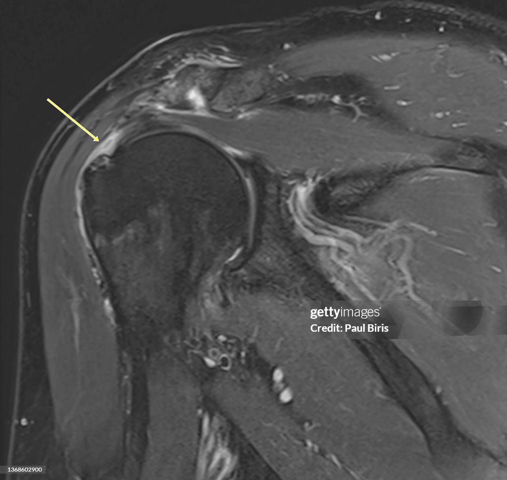 Rotator cuff tear, MRI Shoulder joint Magnetic resonance imaging (MRI)