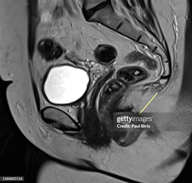 preoperative mri of perianal fistula (arrow) seen on sagittal view - hemorrhoid stock-fotos und bilder