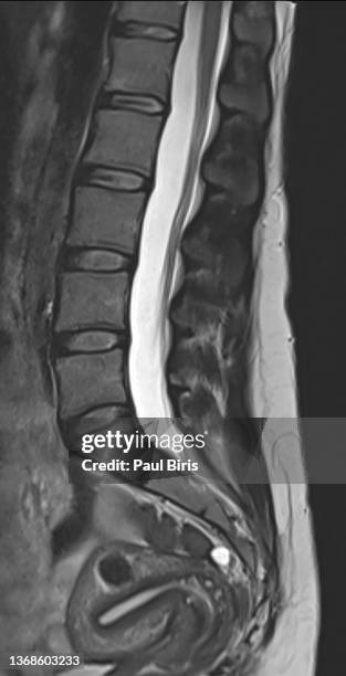 magnetic resonance images of normal lumbar spine sagittal t2-weighted images (mri lumbar spine) - herniated disc 個照片及圖片檔