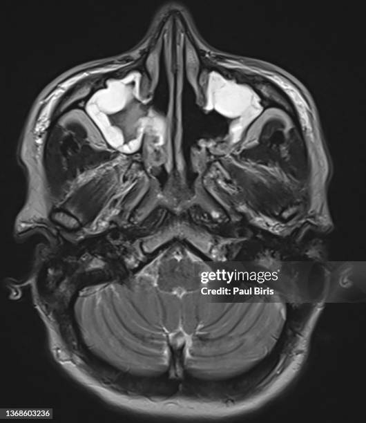 Mri Scan Sinus Machine 116 Sinus Mri Stock Photos, High-Res Pictures, and Images - Getty Images