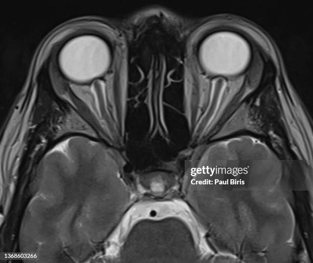 Mri Example Axial 248 Axial Mri Stock Photos, High-Res Pictures, and Images - Getty Images