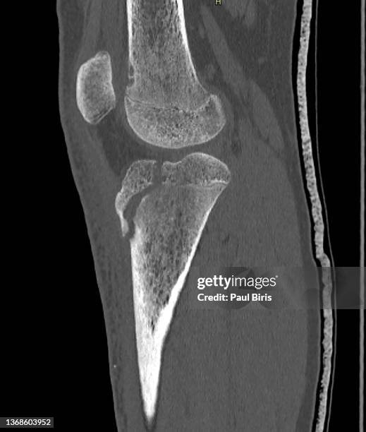 tibial plateau fracture seen on ct saggital recontruction - scheenbeen stockfoto's en -beelden