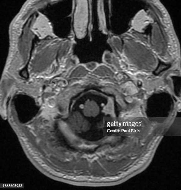small foramen magnum meningioma seen after gadolinium injection on axial t1 mri image - histology 個照片及圖片檔
