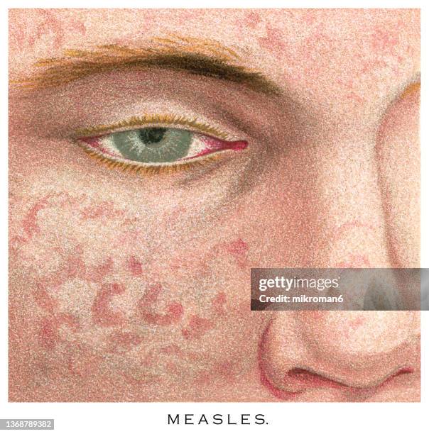 old chromolithograph illustration of skin diseases, measles - biomedical illustration stock pictures, royalty-free photos & images