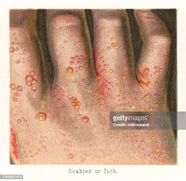 old chromolithograph illustration of skin diseases - scabies, infestation of the skin by the human itch mite - finger print ストックフォトと画像