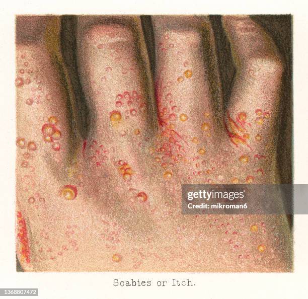 old chromolithograph illustration of skin diseases - scabies, infestation of the skin by the human itch mite - hand eczema stock pictures, royalty-free photos & images