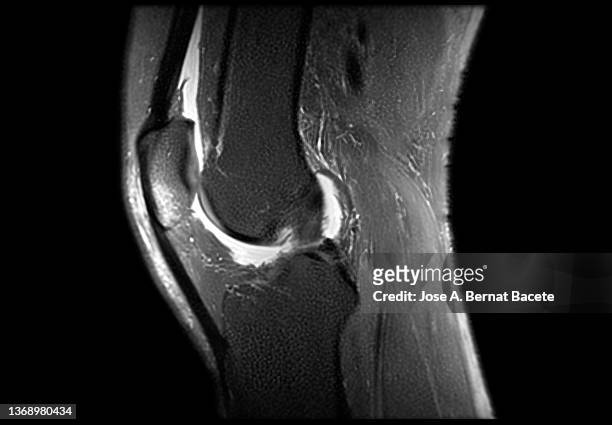 magnetic resonance imaging mri knee. - meniscus stock pictures, royalty-free photos & images