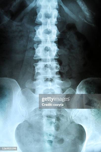 x-ray of pelvis and spinal column. - x ray pelvis stock pictures, royalty-free photos & images