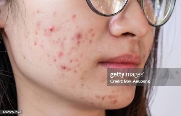 cropped shot of woman having problems of acne inflamed on her cheek. - pimple stock-fotos und bilder