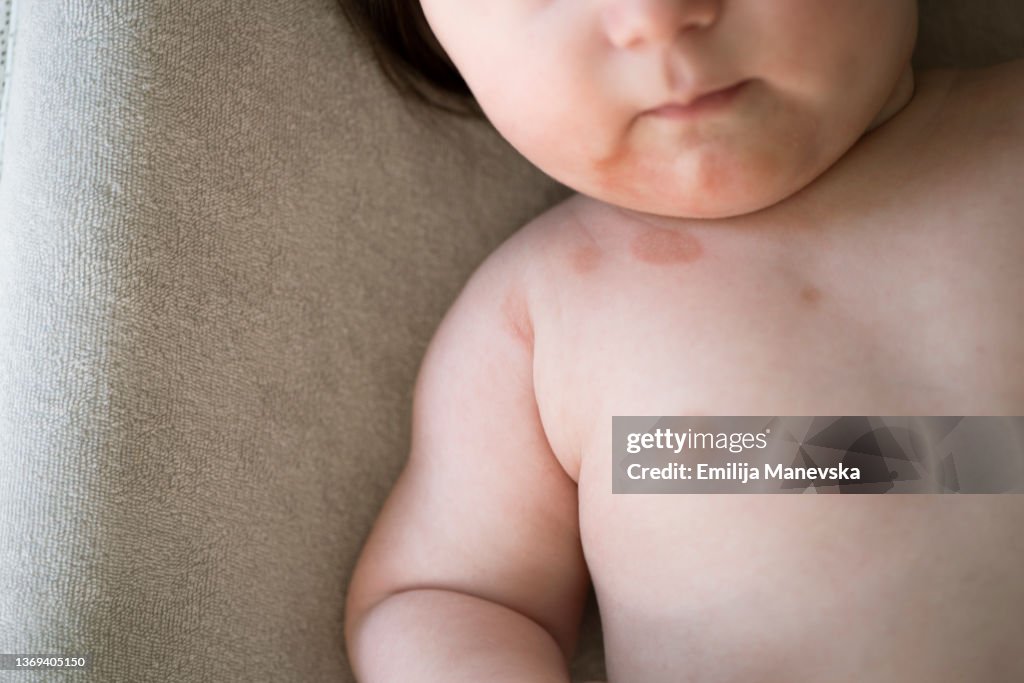 Spit Rash Baby Baby With Skin Rashes High-Res Stock Photo - Getty Images