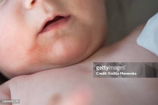 baby with skin rashes - dermatitis stock pictures, royalty-free photos & images