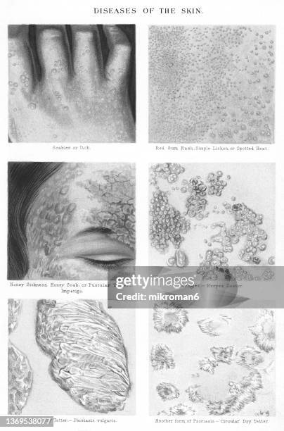 old chromolithograph illustration of skin diseases - impetigo stock-fotos und bilder