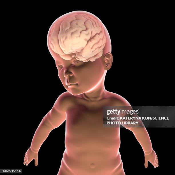 child with macrocephaly and enlarged brain, illustration - hydrocephalus stock illustrations