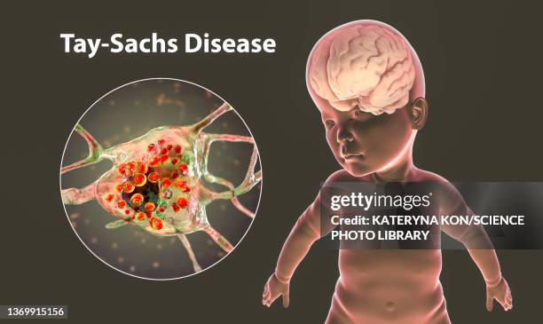 tay-sachs disease, computer illustration - tay sachs stock-grafiken, -clipart, -cartoons und -symbole