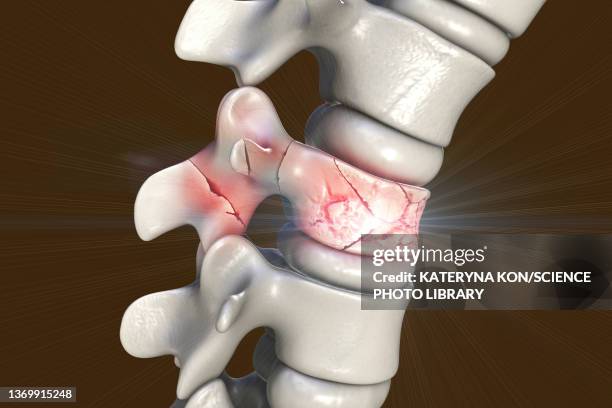 illustrazioni stock, clip art, cartoni animati e icone di tendenza di spinal fracture, illustration - schiacciato
