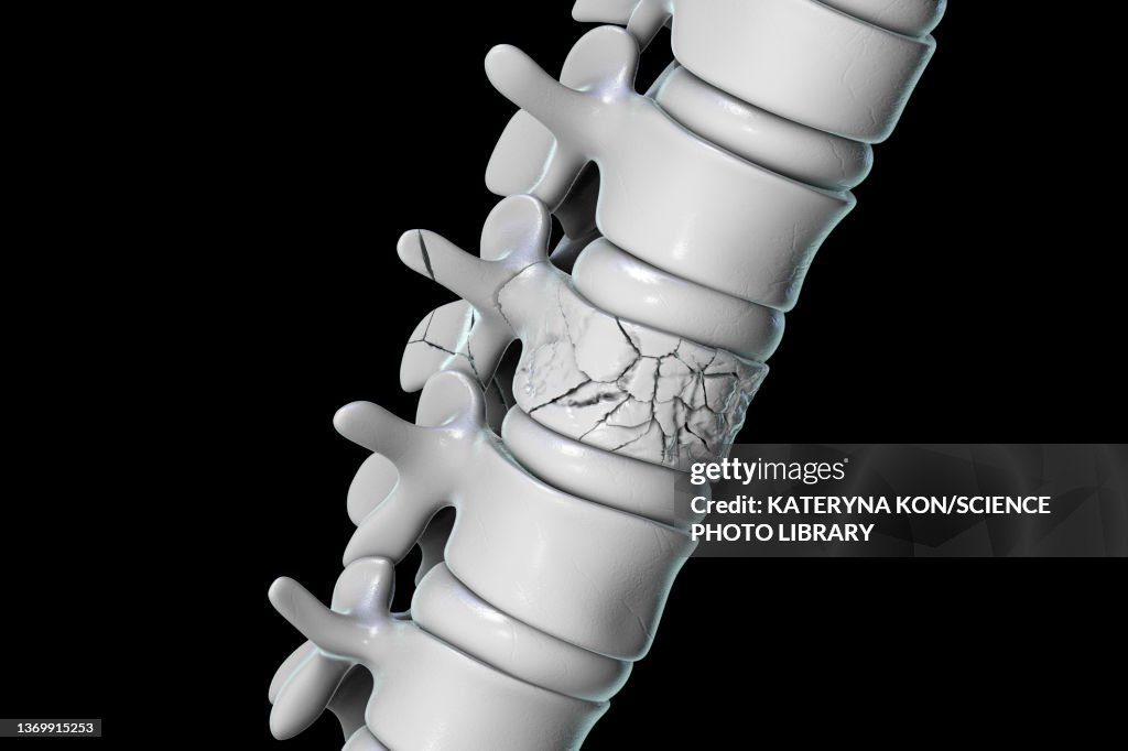 Spinal fracture, illustration