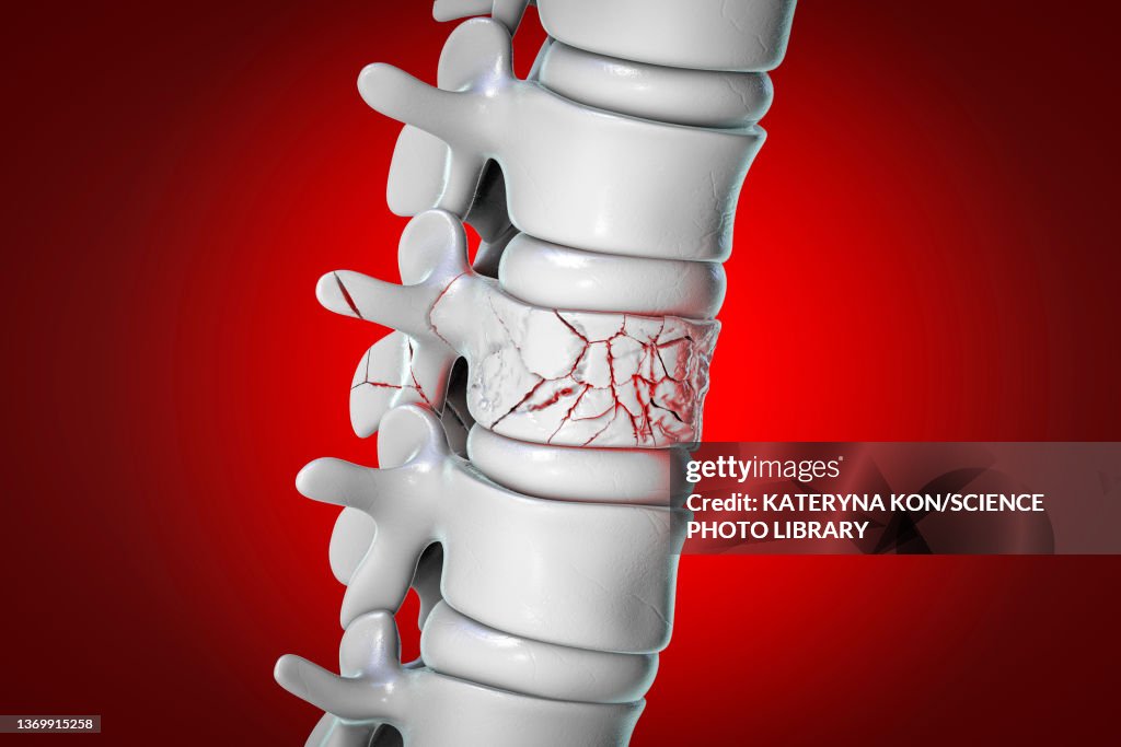 Spinal fracture, illustration