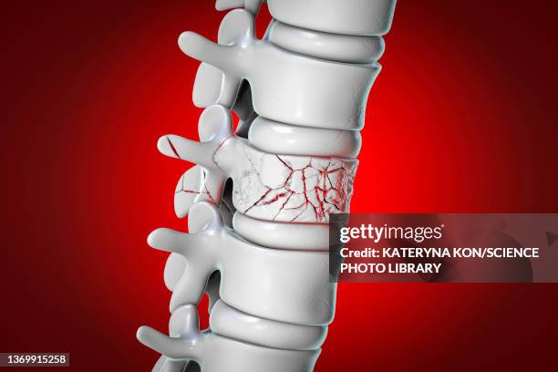 spinal fracture, illustration - fibrocartilage stock illustrations