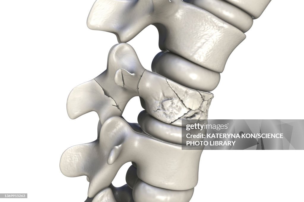 Spinal fracture, illustration