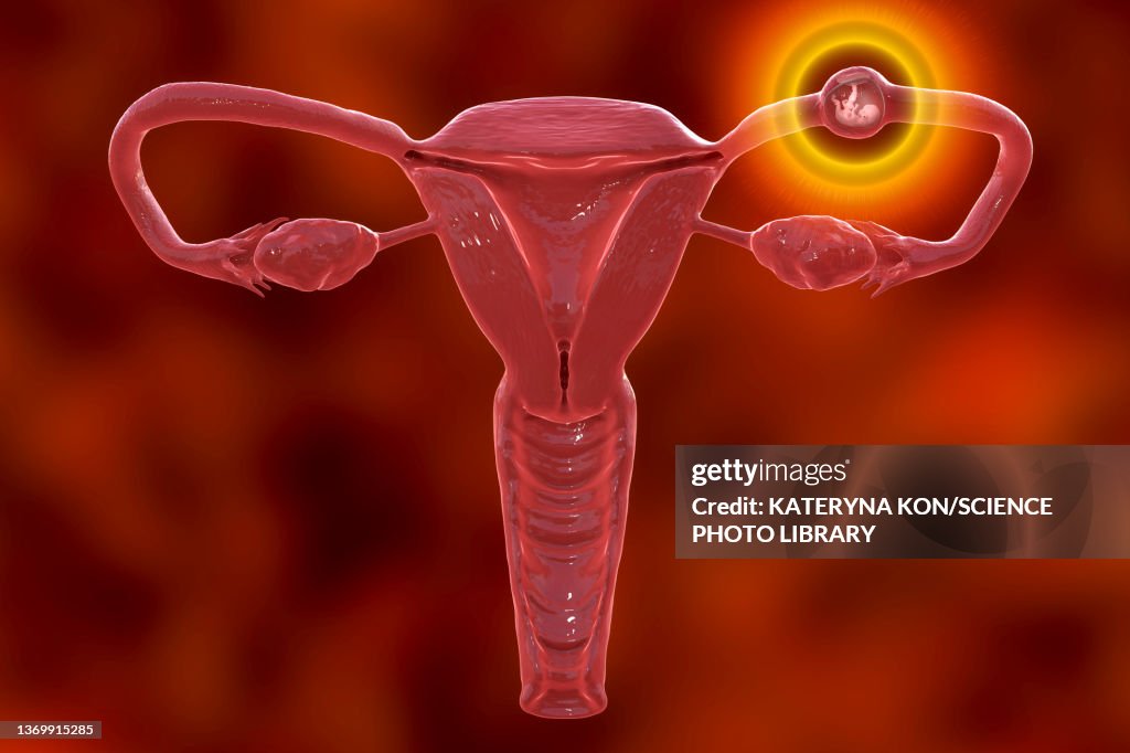 Ectopic pregnancy, illustration