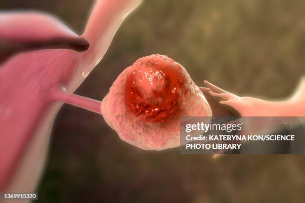 ovarian cancer, illustration - female reproductive organ stock pictures, royalty-free photos & images