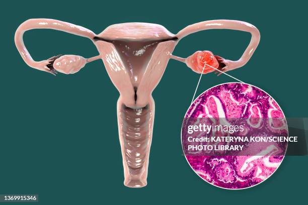 ovarian cancer, illustration - eierstokkanker stockfoto's en -beelden