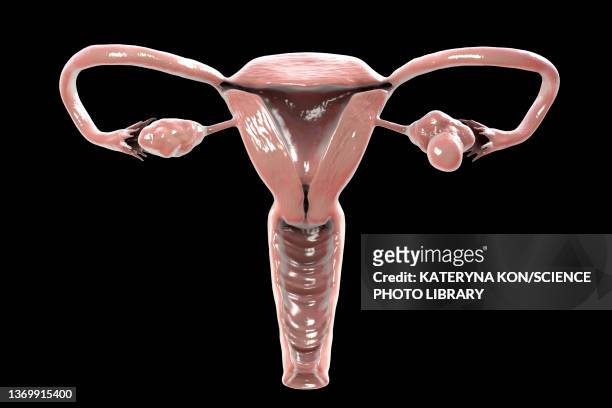 polycystic ovary syndrome, illustration - ovaries 幅插畫檔、美工圖案、卡通及圖標