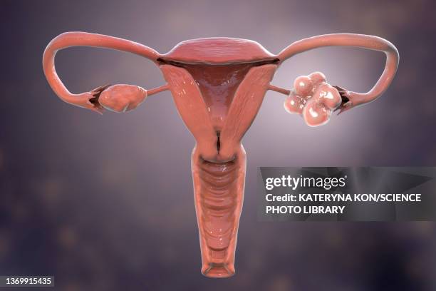 polycystic ovary syndrome, illustration - polycystic ovary syndrome stock illustrations