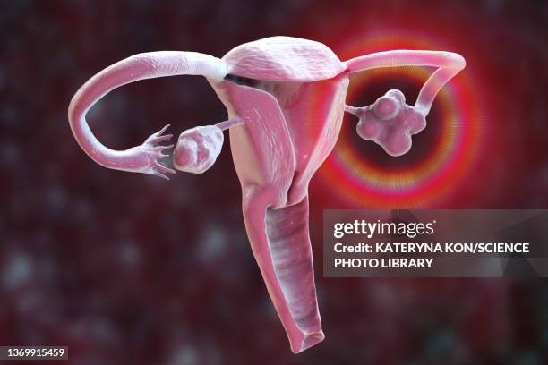 polycystic ovary syndrome, illustration - ovaries 幅插畫檔、美工圖案、卡通及圖標