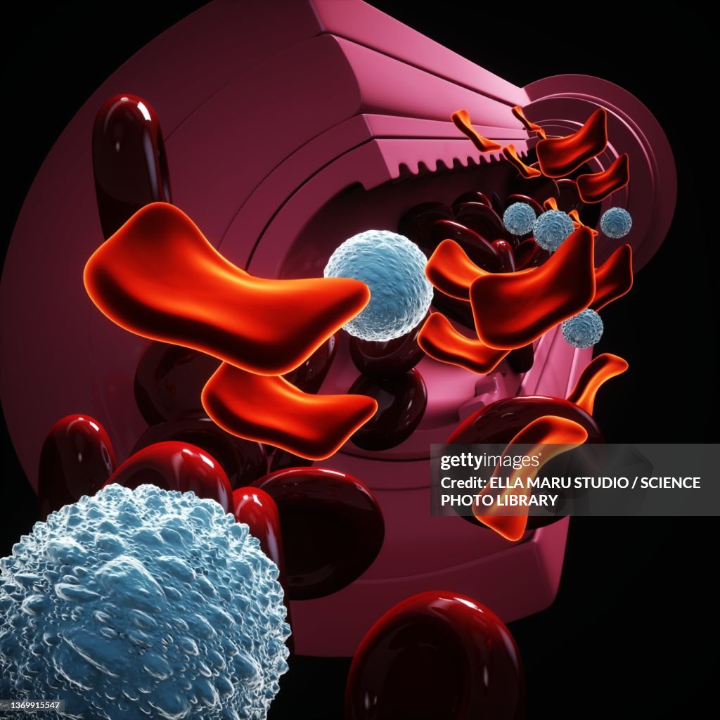 Thalassemia, illustration