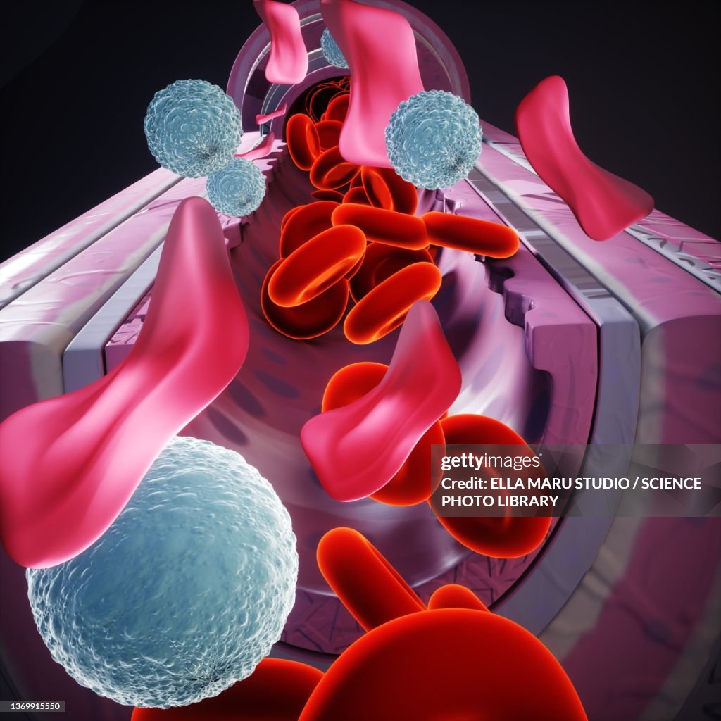 Thalassemia, illustration
