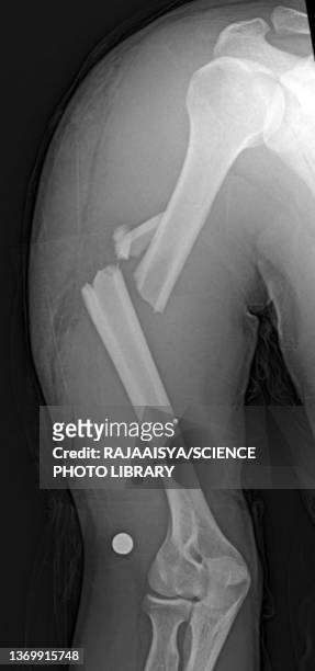 fractured arm, x-ray - benton bildbanksfoton och bilder