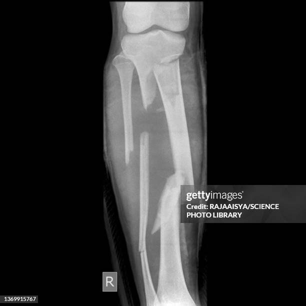 fractured leg, x-ray - comminuted fracture stock pictures, royalty-free photos & images