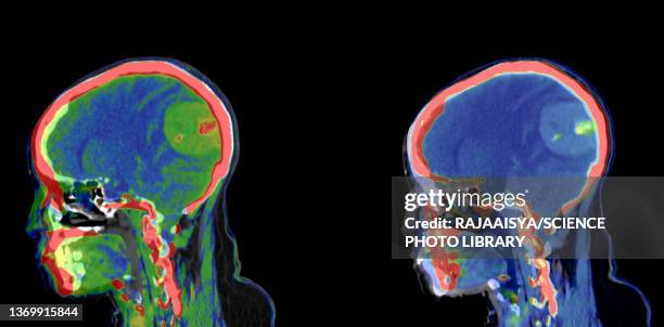 meningioma, ct scan - meningeom stock-fotos und bilder