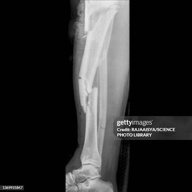 fractured leg, x-ray - comminuted fracture stock pictures, royalty-free photos & images