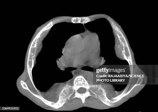 Normal Ct Scan Ribs Rib Cage Photos and Premium High Res Pictures - Getty Images