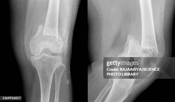 fractured leg, x-ray - femur stock pictures, royalty-free photos & images