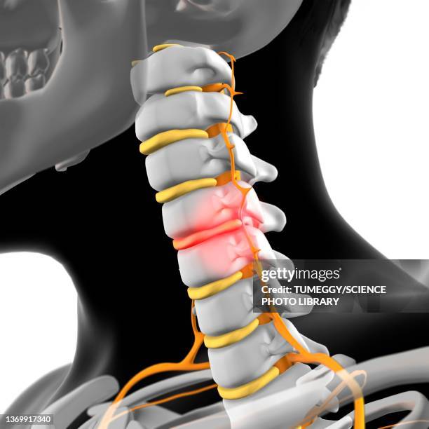 cervical disc herniation, illustration - herniated disc 幅插畫檔、美工圖案、卡通及圖標