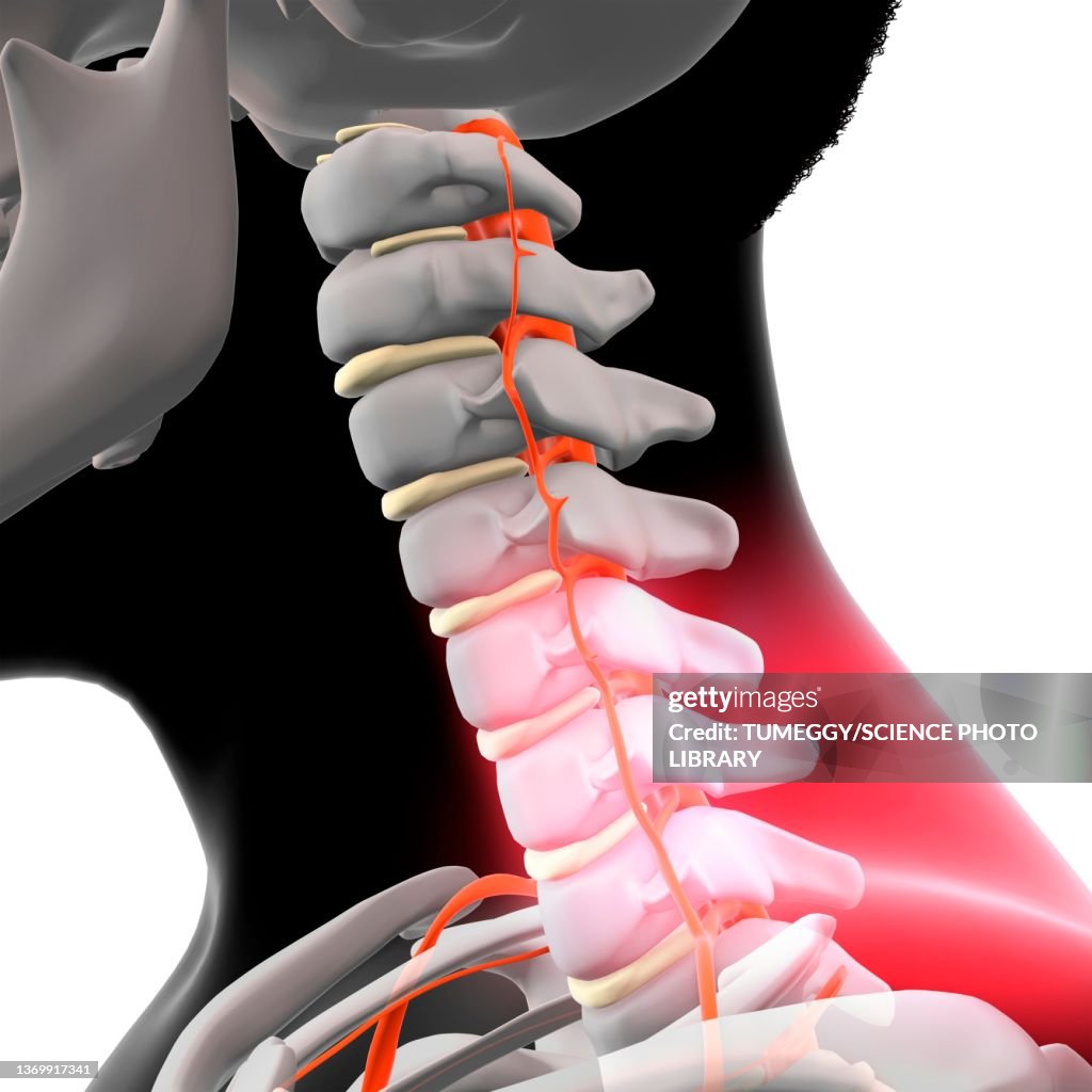 Neck pain, illustration