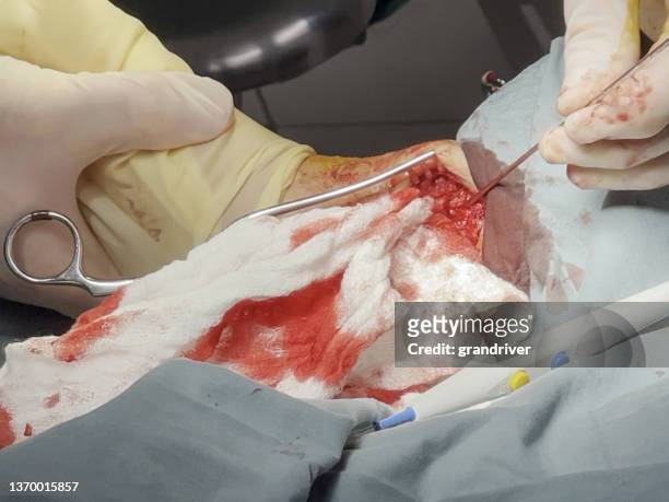 orthopädischer chirurg führt eine schwierige knöcheloperation durch, nahaufnahme - achilles tendon stock-fotos und bilder