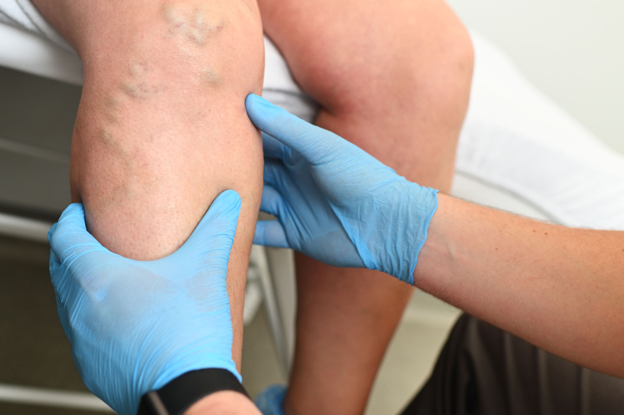 vein disease