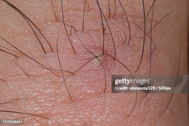 inflammation caused by ingrown hair,close-up of human hand - ingrown hair imagens e fotografias de stock