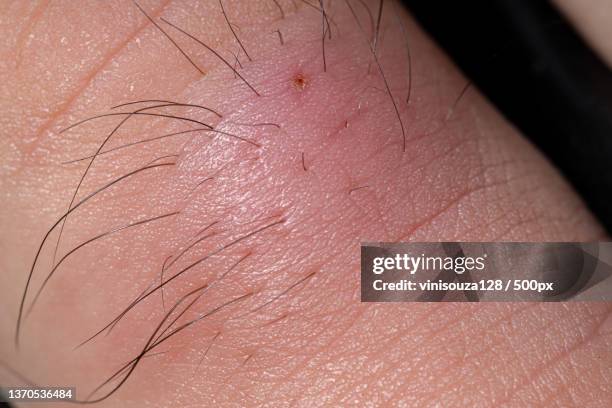 inflammation caused by ingrown hair,close-up of human hand - ingrown hair imagens e fotografias de stock