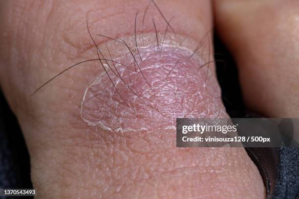 healing process of the skin,close-up of human hand - ingrown hair stock pictures, royalty-free photos & images