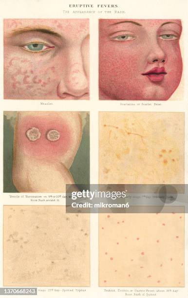 old chromolithograph illustration of skin diseases - dermatitis stock pictures, royalty-free photos & images