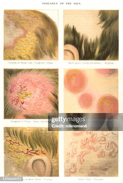 old chromolithograph illustration of skin diseases - impetigo stock-fotos und bilder