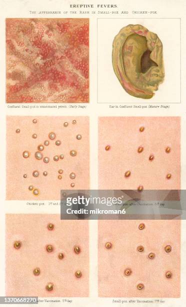 old chromolithograph illustration of skin diseases - impetigo stock-fotos und bilder