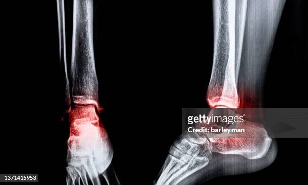 x-ray of a foot with sports injury - broken heel stock-fotos und bilder